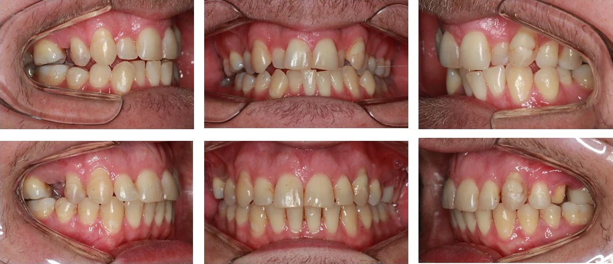 Antes e depois de tratamento ortodôntico concluído em 13 meses