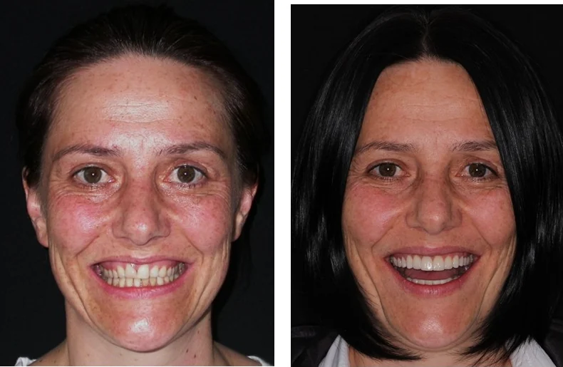 Antes e depois de tratamento ortodôntico concluído em 14 meses